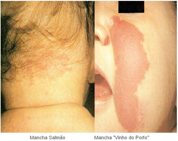 No membro a cabeça aumentada na criança